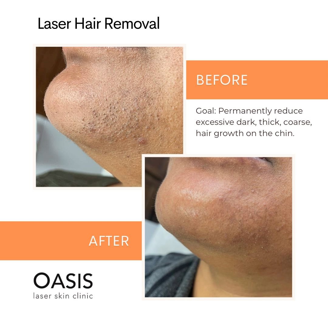 laser hair removal in bridgeland, calgary
