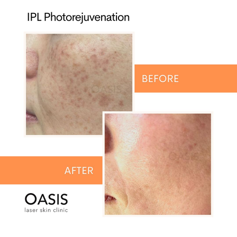 intense pulsed light therapy in bridgeland, calgary