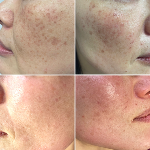 intense pulsed light therapy near you