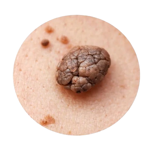 skin tags and warts