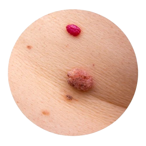 treatment for angiomas, milia, and molluscum