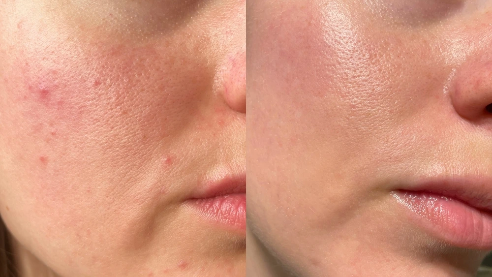how acne treatments improve skin health over time
