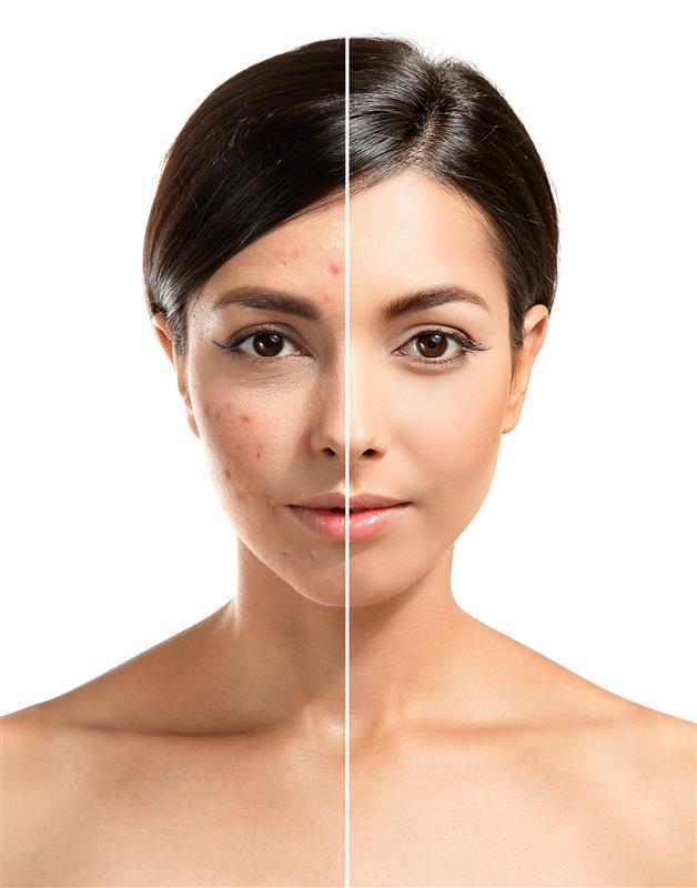 Salicylic Peel